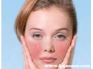 面膜过敏红肿痒怎么办，敷完面膜脸颊发红是什么原因